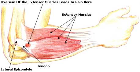 Elbow Overuse Illustration