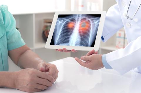 A Closer Look at Lung Cancer Screening 